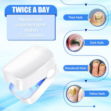 12915 Rechargeable Nail Fungus Treatment for Toenail, Toe Nail Fungal Treatment Nail Fungus Laser Device, Anti-Fungal Nail Treatment for Hand & Feet Infections Remover for Home Use